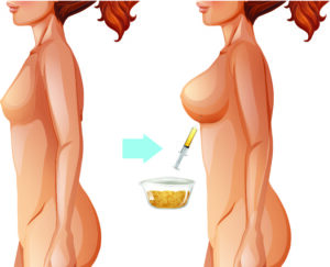 fat transfer breast augmentation
