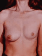 uneven breast surgery