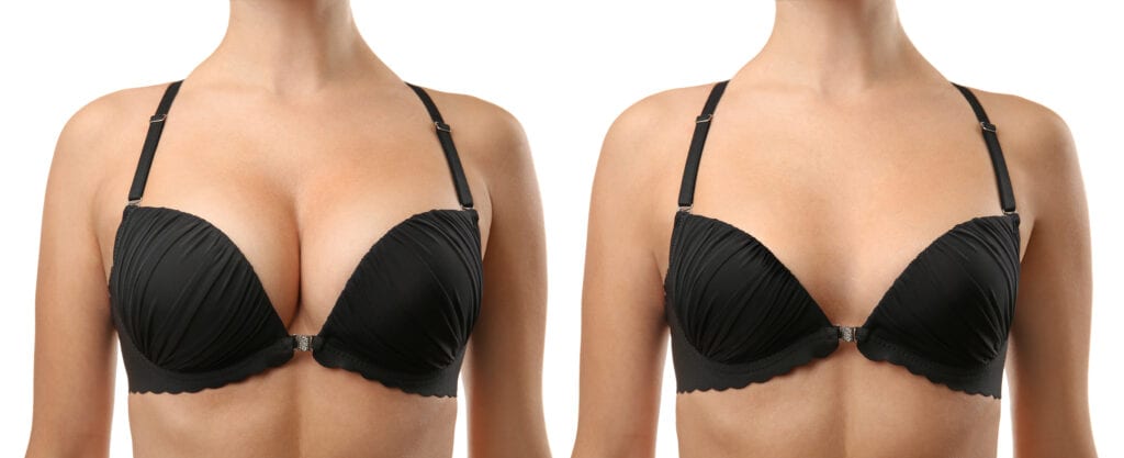 Breast Augmentation  Dr. Lorelei Grunwaldt