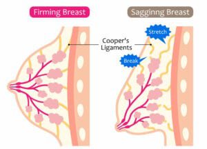 Breast lift surgery Pittsburgh