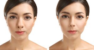 rhinoplasty